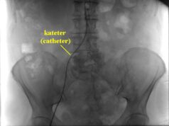 Imagen de angiografía selectiva con catéter; archivo de 2011, alusivo a los procedimientos vasculares.